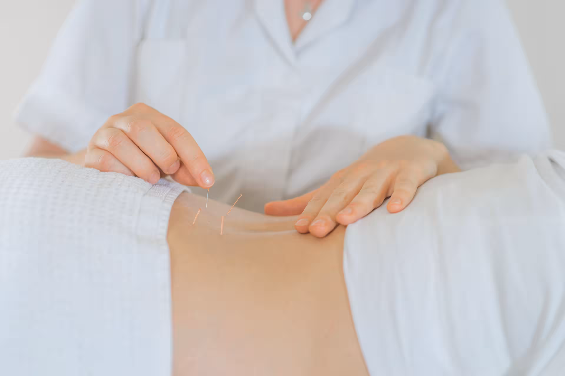 Acupuncture converted